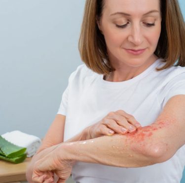 L’Aloe Vera soulage les démangeaisons cutanées??