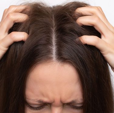 Démangeaison du cuir chevelu : remèdes naturels efficaces