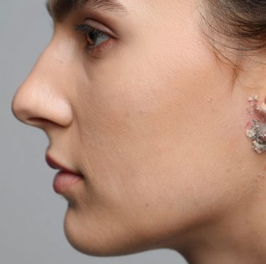 Eczéma de l’oreille : quel traitement naturel choisir ?