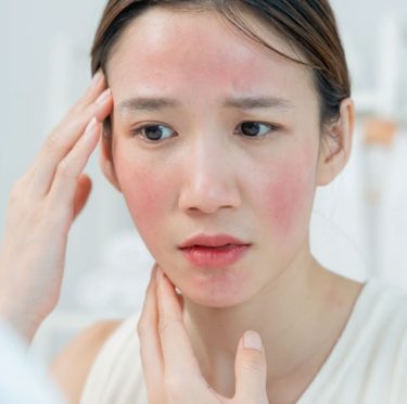 Peau sensible et réactive : le guide du soin naturel