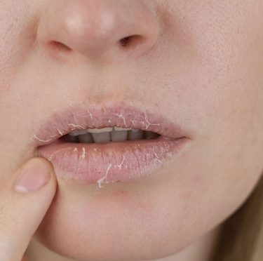 Quels remèdes naturels pour les lèvres gercées ?