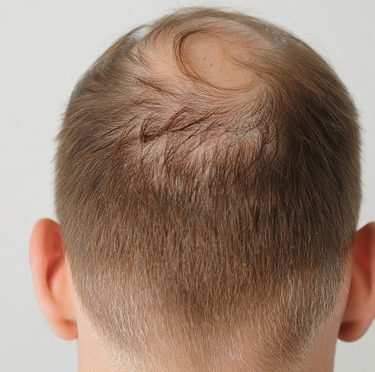 Calvitie : 6 solutions naturelles pour la repousse