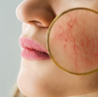Traitement naturel rosacée : les meilleures solutions